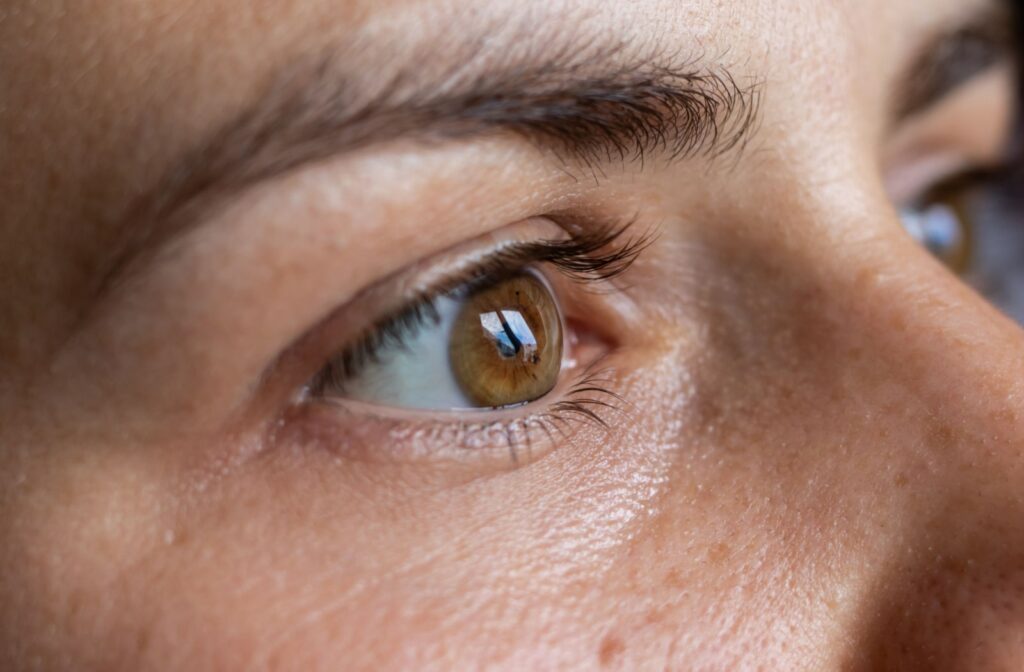 A close-up view of a woman's eye with keratoconus present on her cornea