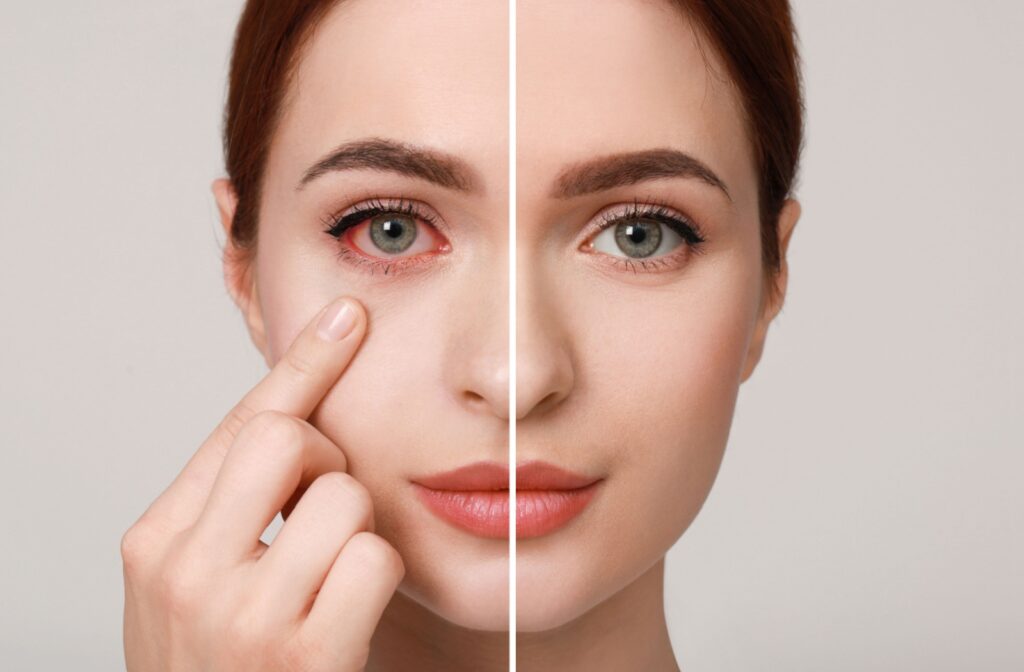 Split image of a woman’s face showing a comparison between an eye with redness and irritation and a healthy, clear eye, highlighting the visible symptoms of eye inflammation.