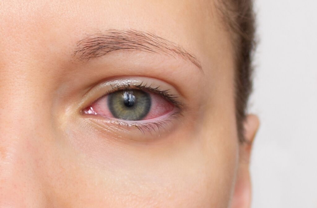 Close-up of an eye with visible redness around the white (scleral) area.