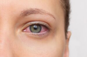 Close-up of an eye with visible redness around the white (scleral) area.